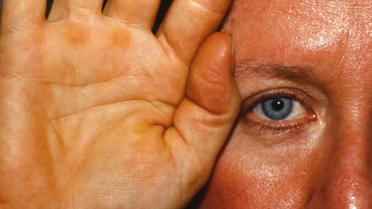 Los Efectos Reales de Comer Zanahorias Diariamente 1 carotenosis